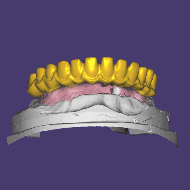 Milling Titanium Abutment