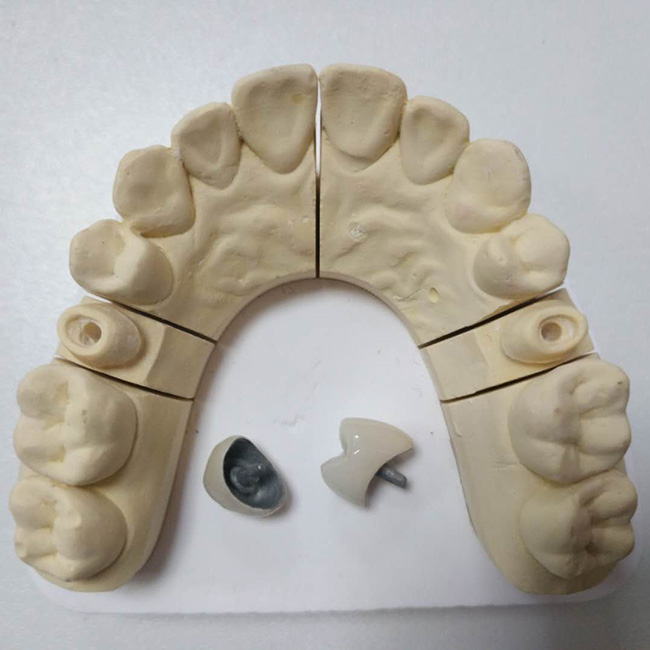 Post and Core