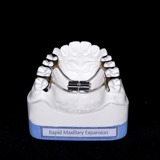 Rapid Maxillary Expansion